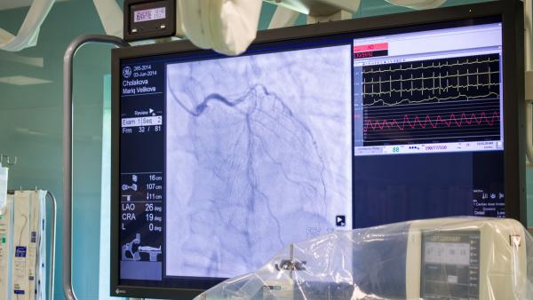 Инвазивни кардиолози извадиха чуждо тяло от сърцето на жена без операция