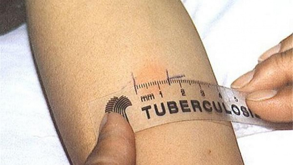 Безплатни прегледи за туберкулоза ще се извършват в Стара Загора от 15 до 19 юни
